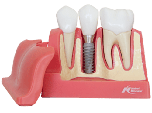 Dental implants