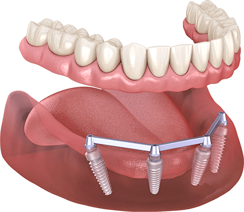 Implant prothesis with a bar