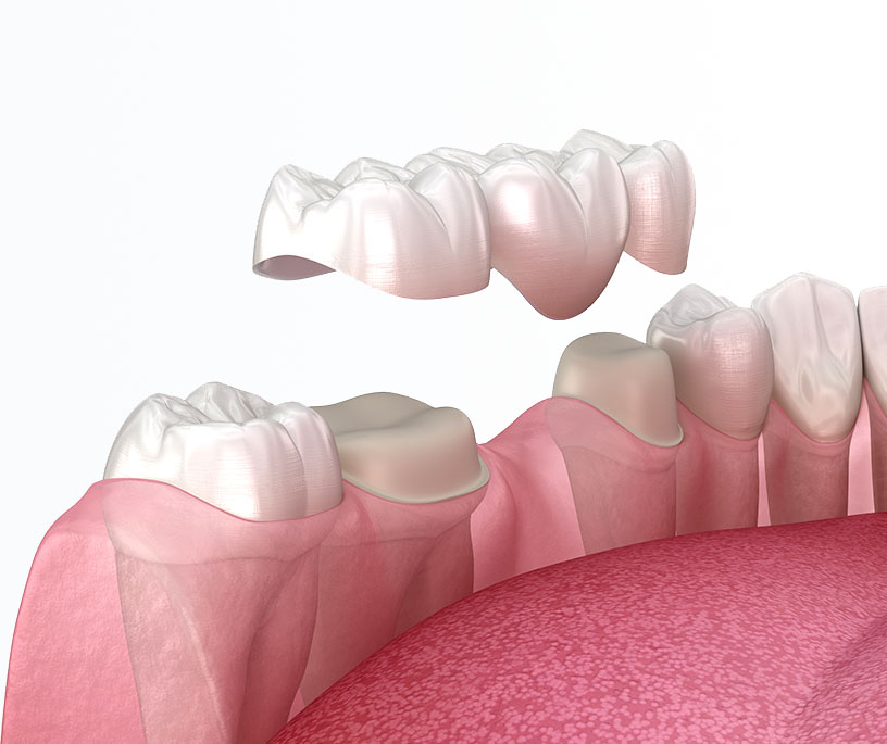 Bridge on natural teeth