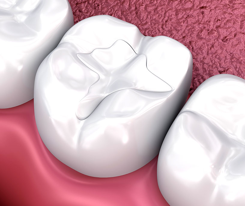 Composite aesthetic fillings