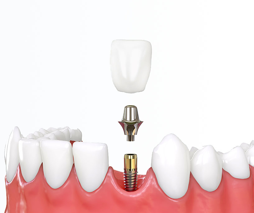 Crown on an implant